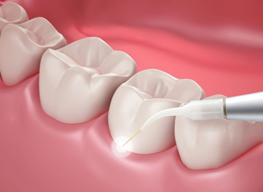 LASER GUM TREATMENT