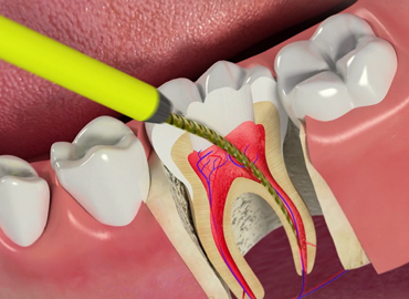 ROOT CANAL TREATMENT