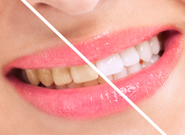 TEETH WHITENING/ BLEACHING