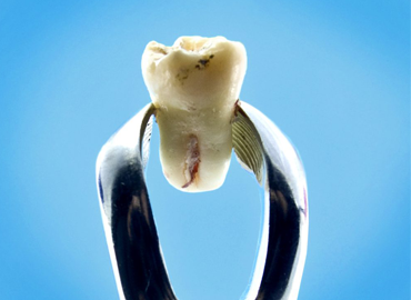 WISDOM TOOTH REMOVAL